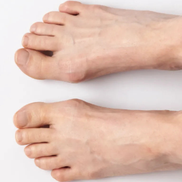 Combating Bunions