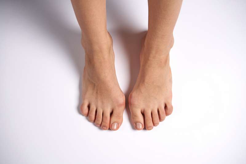 Are Bunions Genetic?