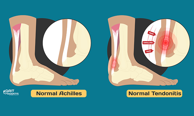 Know the Symptoms of Achilles Tendonitis / Tendinopathy